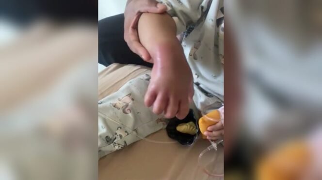 
					Tangan Bayi 1,5 Tahun Membengkak Dan Terjadi Perburukan Kondisi Pasca Diinfus Di RSUD Nunukan, Anggota DPRD Curhat Di Medsos